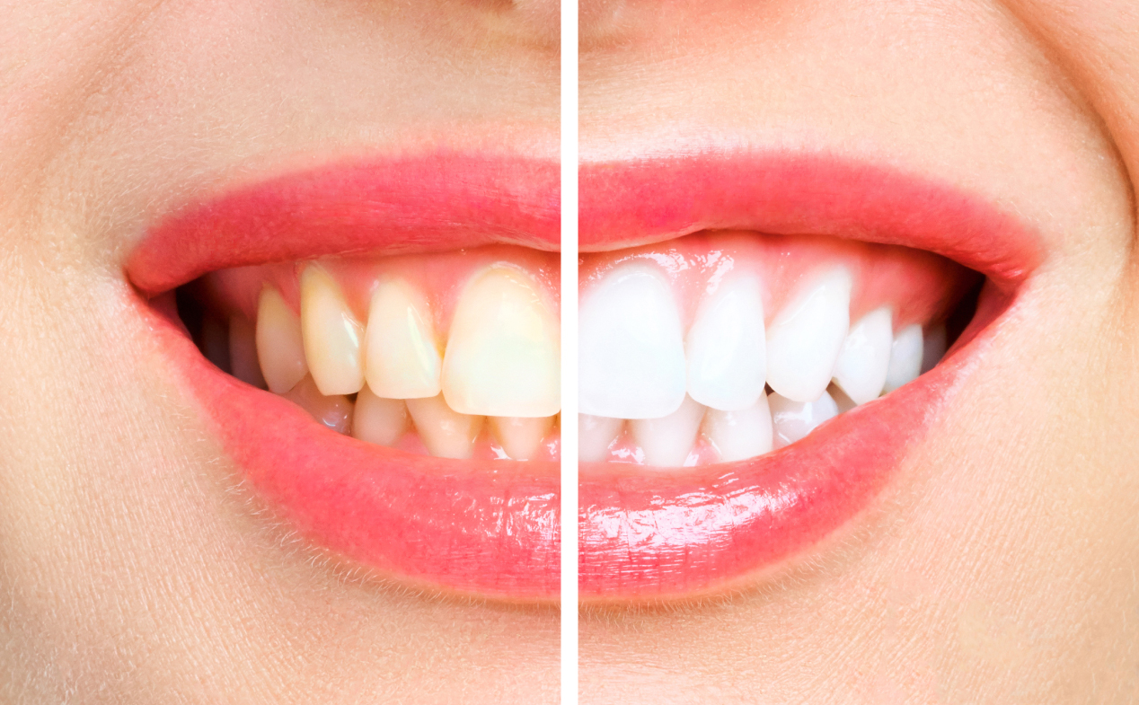 Bělení zubů